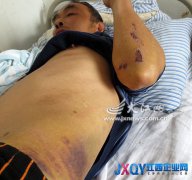 工人摔傷后雇主避而不見 南昌加迪豪鋁業有限公