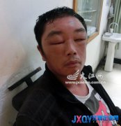 萍鄉一男子過節染發 染得腦袋腫大[圖]