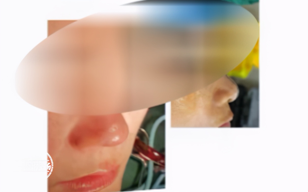 女子隆鼻后紅腫不透氣 江西省皮膚病專科醫院被投訴